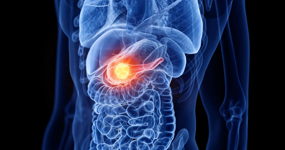 Estudo revela proteína ligada ao avanço do câncer de pâncreas pelos nervos