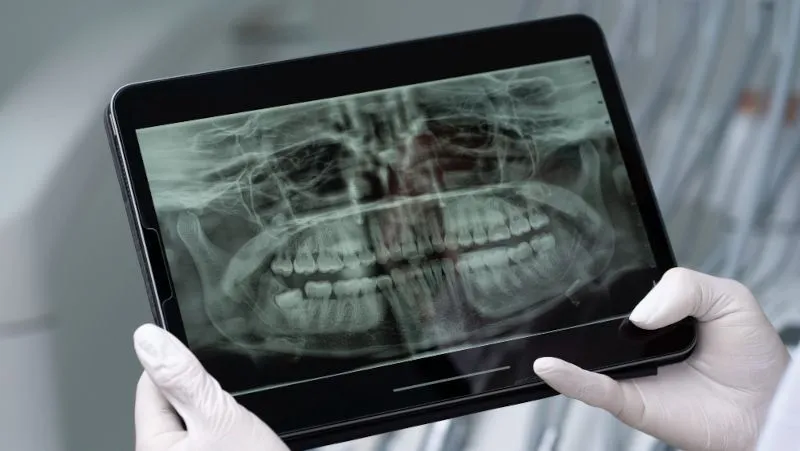 Saliva artificial ajuda a proteger dentes de pacientes com câncer de cabeça